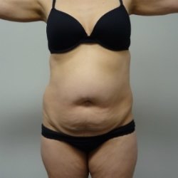 Manhattan abdominoplasty before 7